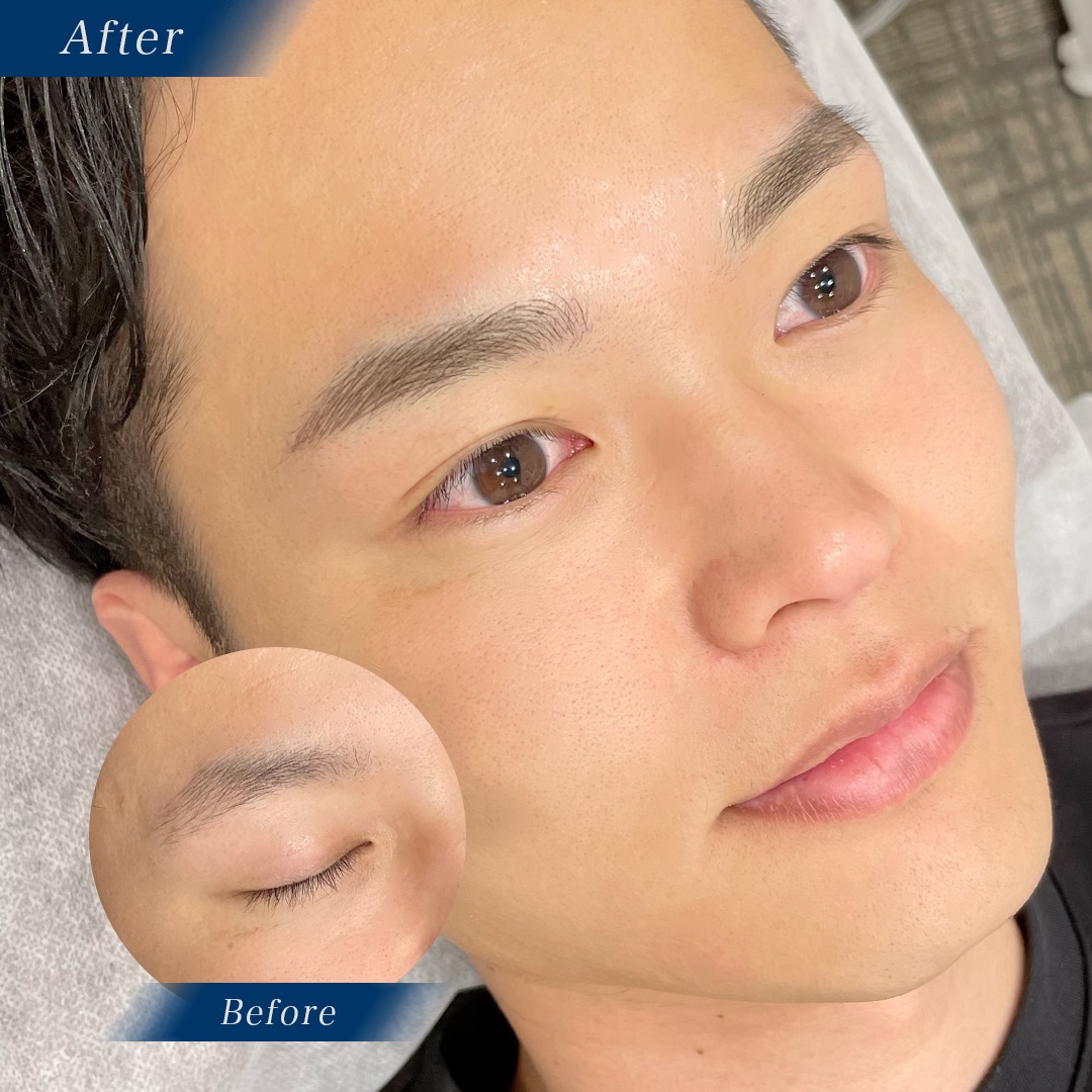 医療アートメイク症例写真　眉　毛並み技法東京・恵比寿のアートメイクラボ