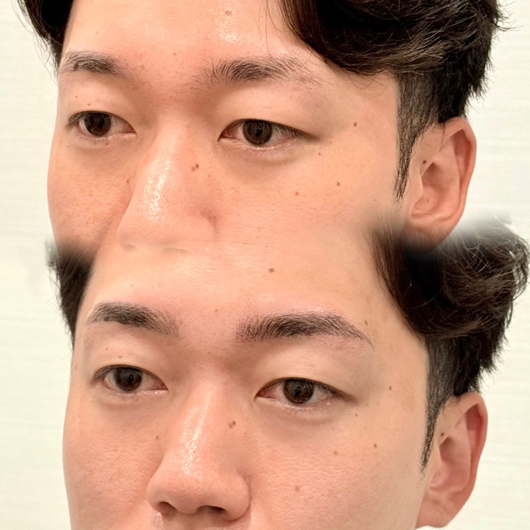 医療アートメイク症例写真　｜毛並み｜パウダーストレート眉　東京・恵比寿のアートメイクラボ
