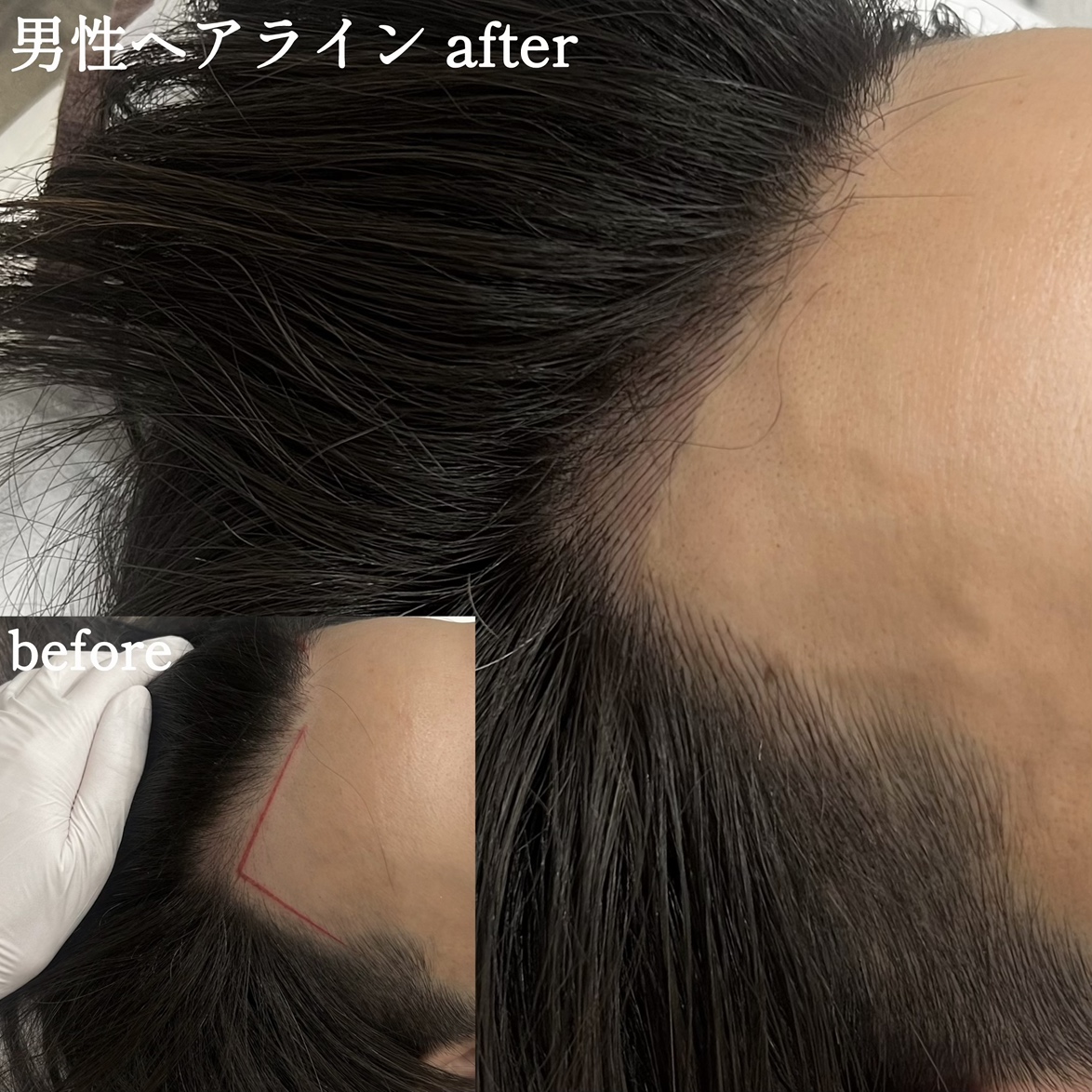 医療アートメイク症例写真　ヘアアートメイク　ヘアラインM字　 東京・恵比寿のアートメイクラボ