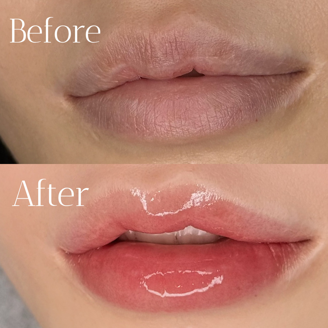 医療アートメイク症例写真　リップ　　東京・恵比寿のアートメイクラボ