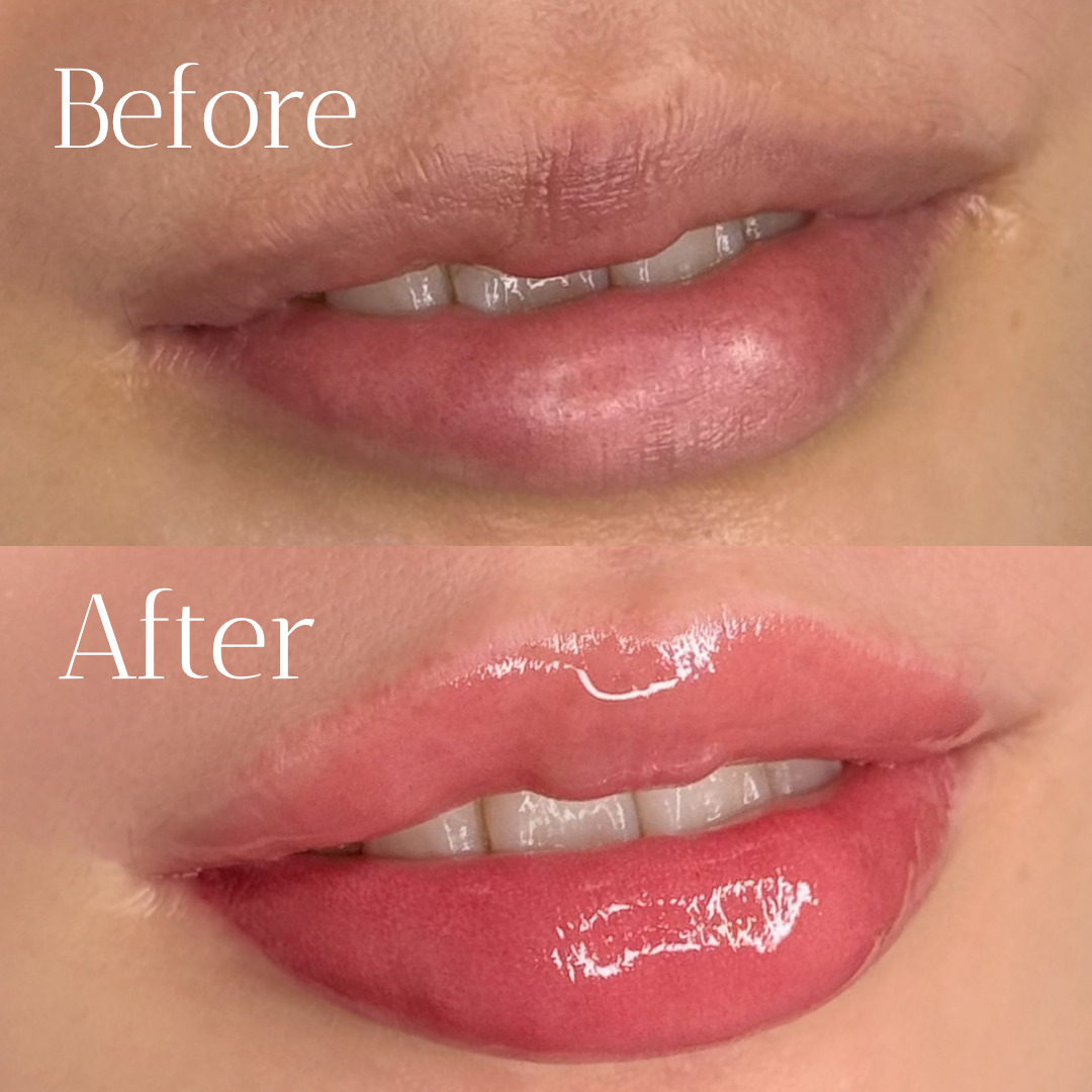 医療アートメイク症例写真　｜リップ　東京・恵比寿のアートメイクラボ