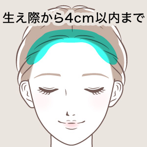 医療アートメイク症例写真 ヘアアートメイク M字部分 （ストロークまたはパウダー）