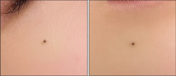 医療アートメイク症例写真　ほくろ　東京・恵比寿のアートメイクラボ