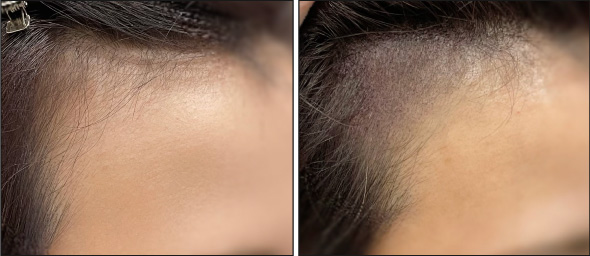 医療アートメイク症例写真　ヘアアートメイク 東京・恵比寿のアートメイクラボ