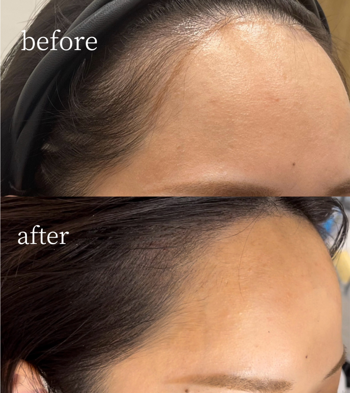 医療アートメイク症例写真　ヘアアートメイク　M字　パウダー　ビフォーアフター　東京・恵比寿のアートメイクラボ