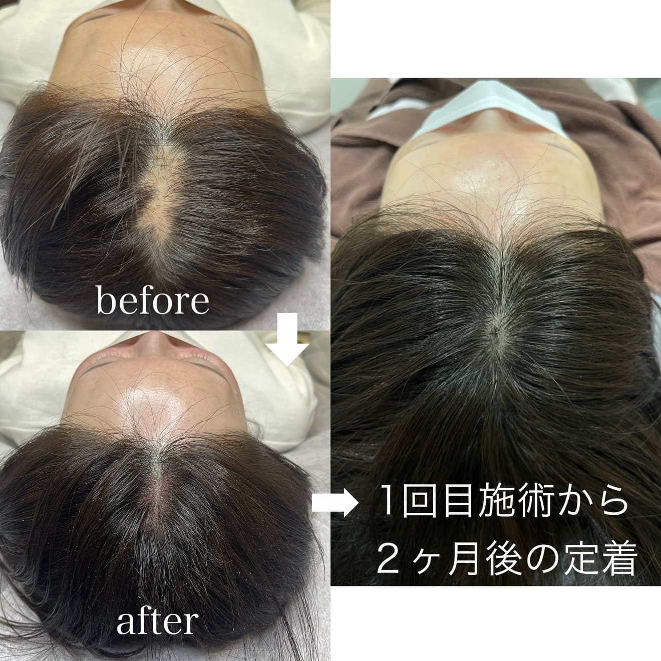 医療アートメイク症例写真　ヘアアートメイク　つむじ　ドット状パウダー 東京・恵比寿のアートメイクラボ