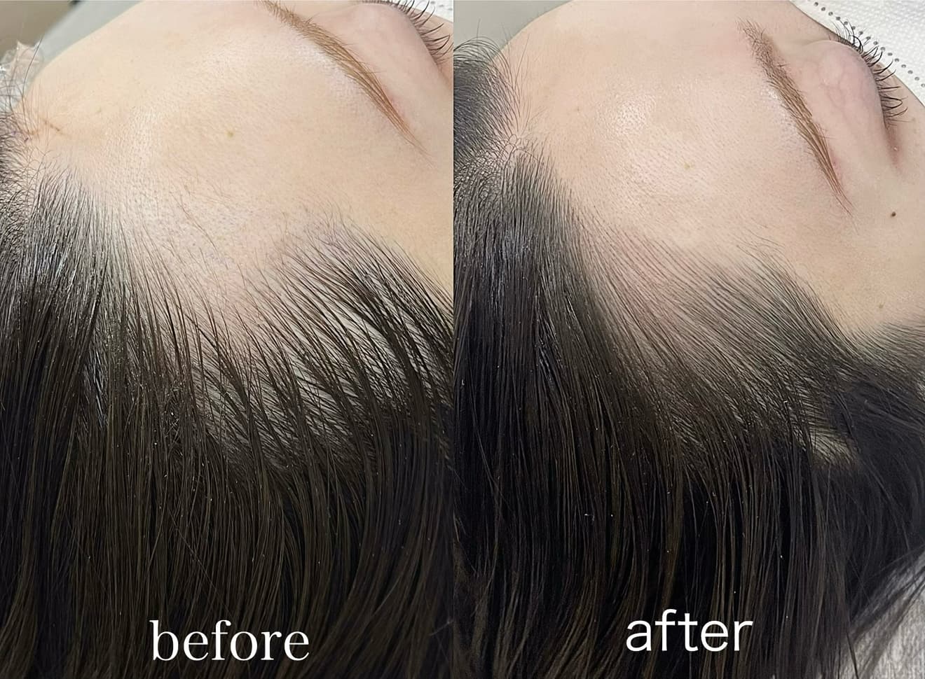 医療アートメイク症例写真　ヘアアートメイク　M字　マシンストローク　ビフォーアフター　東京・恵比寿のアートメイクラボ