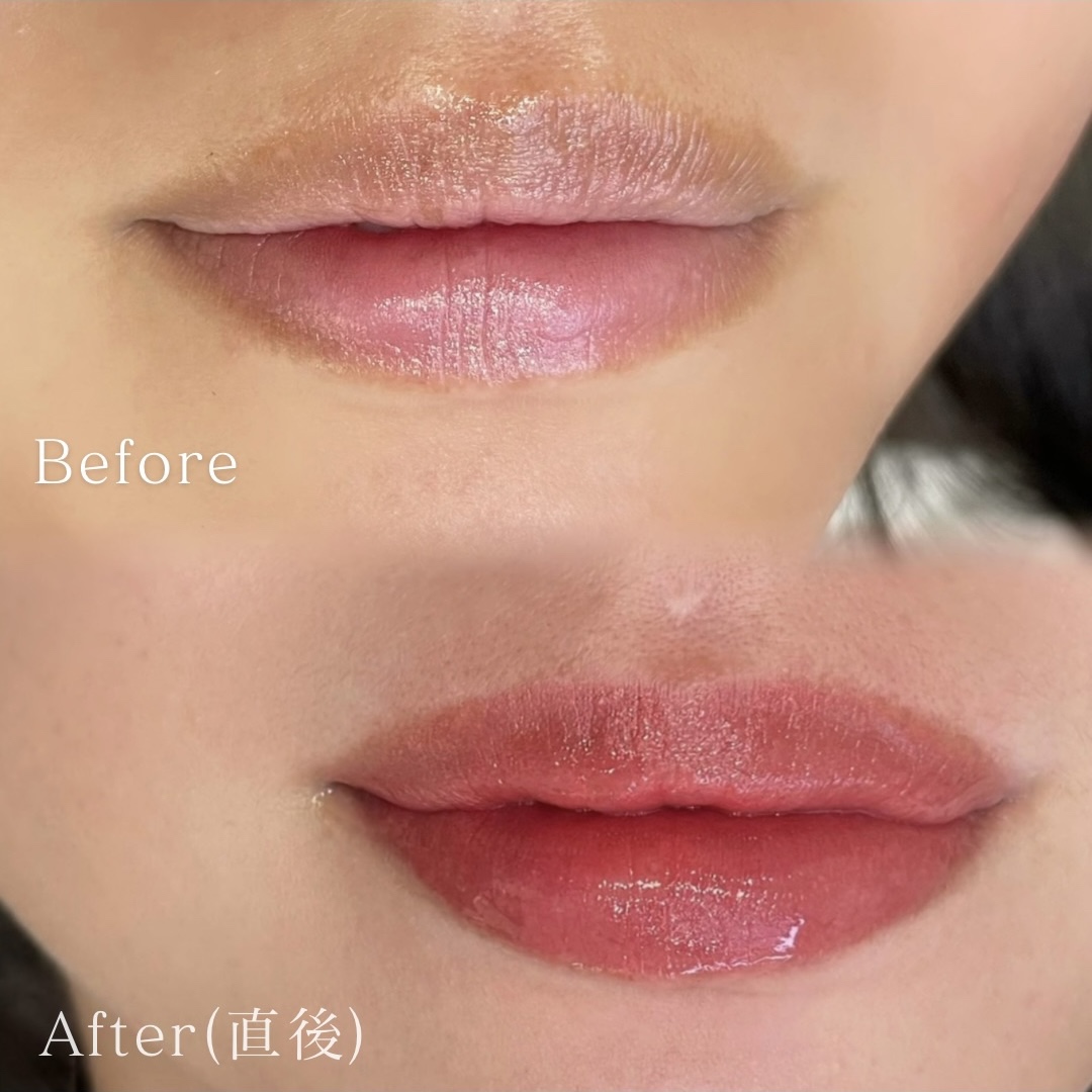 医療アートメイク症例写真　リップ　東京・恵比寿のアートメイクラボ